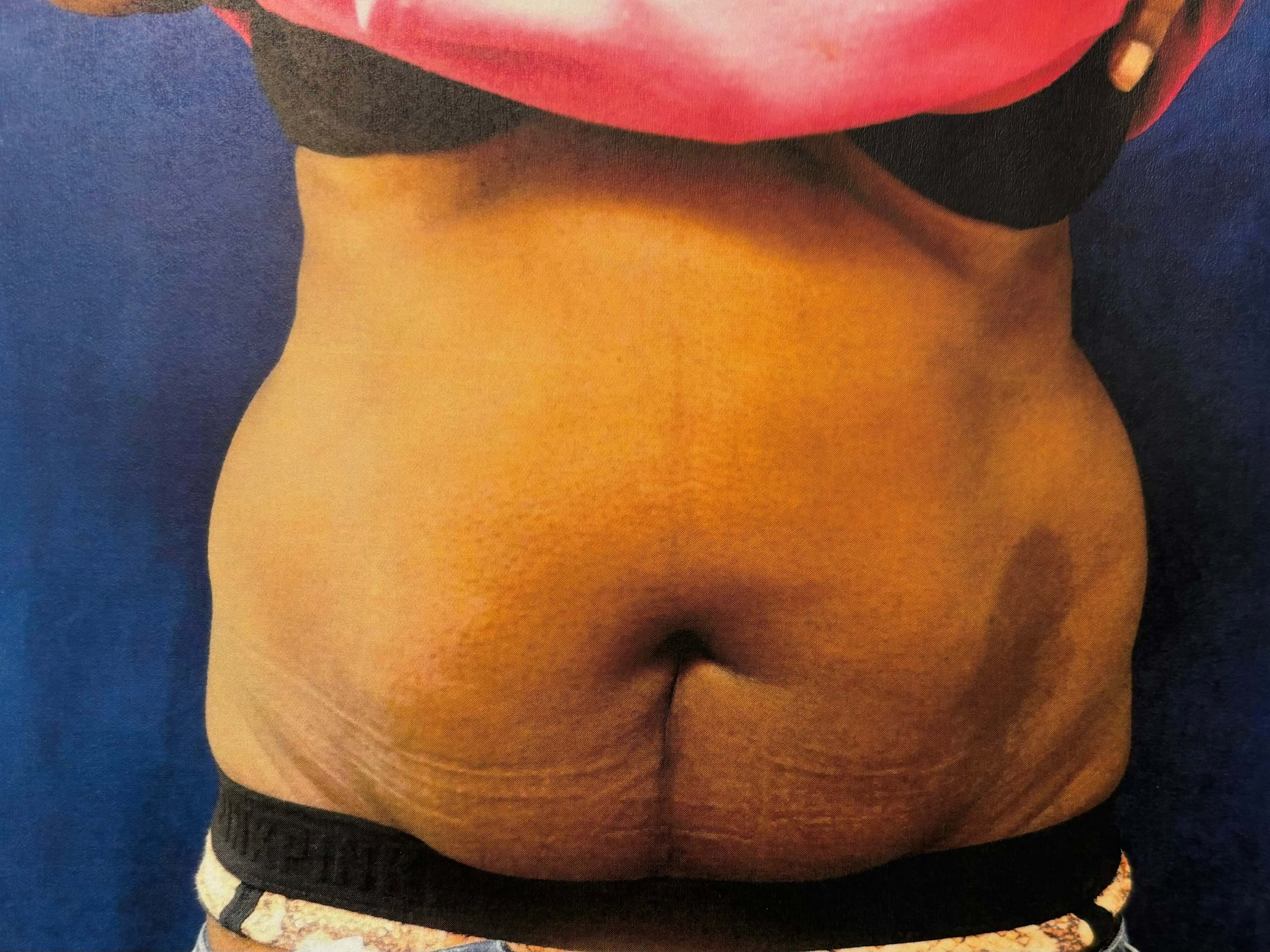 ABDOMINOPLASTY Before