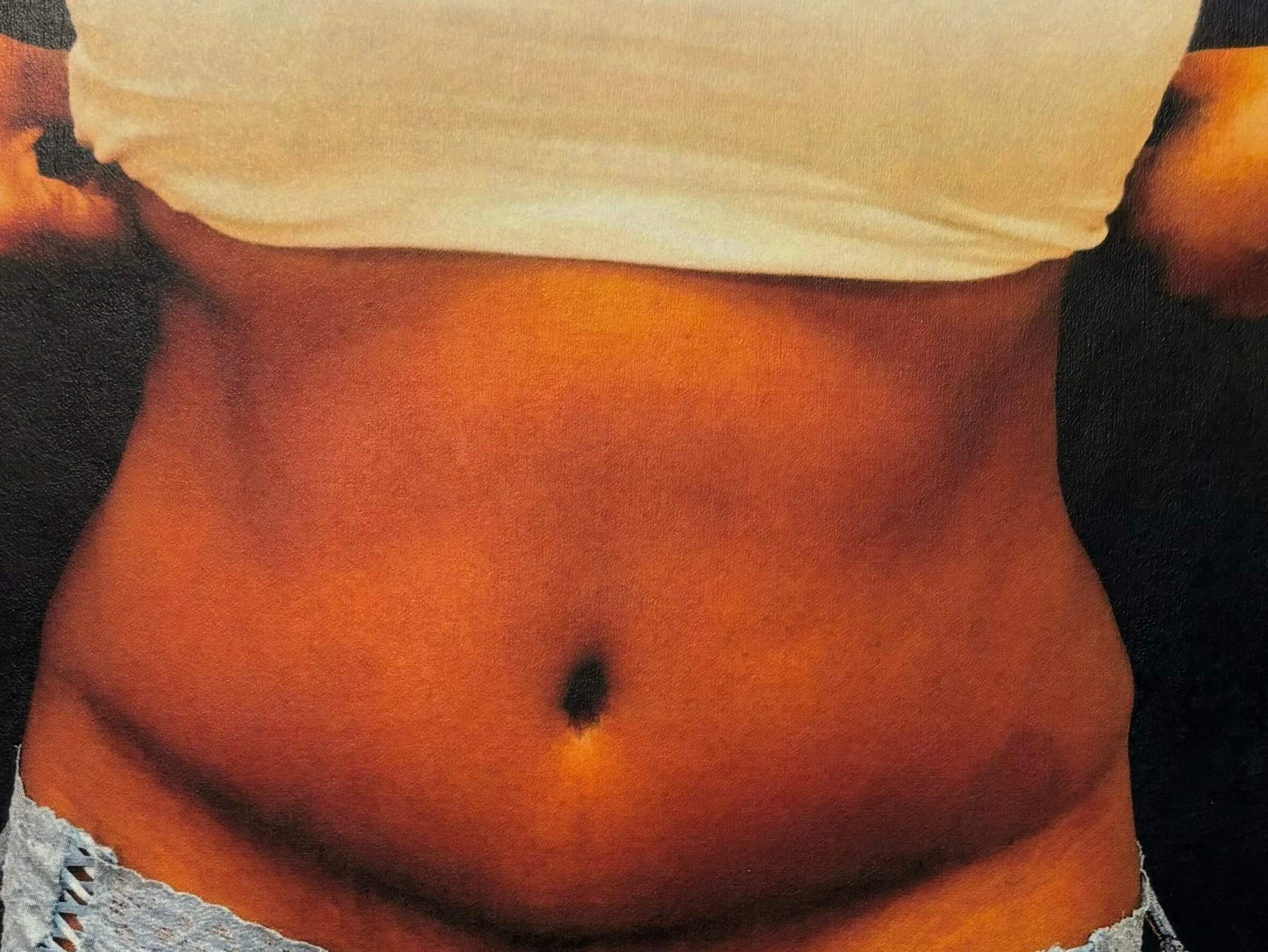 ABDOMINOPLASTY After