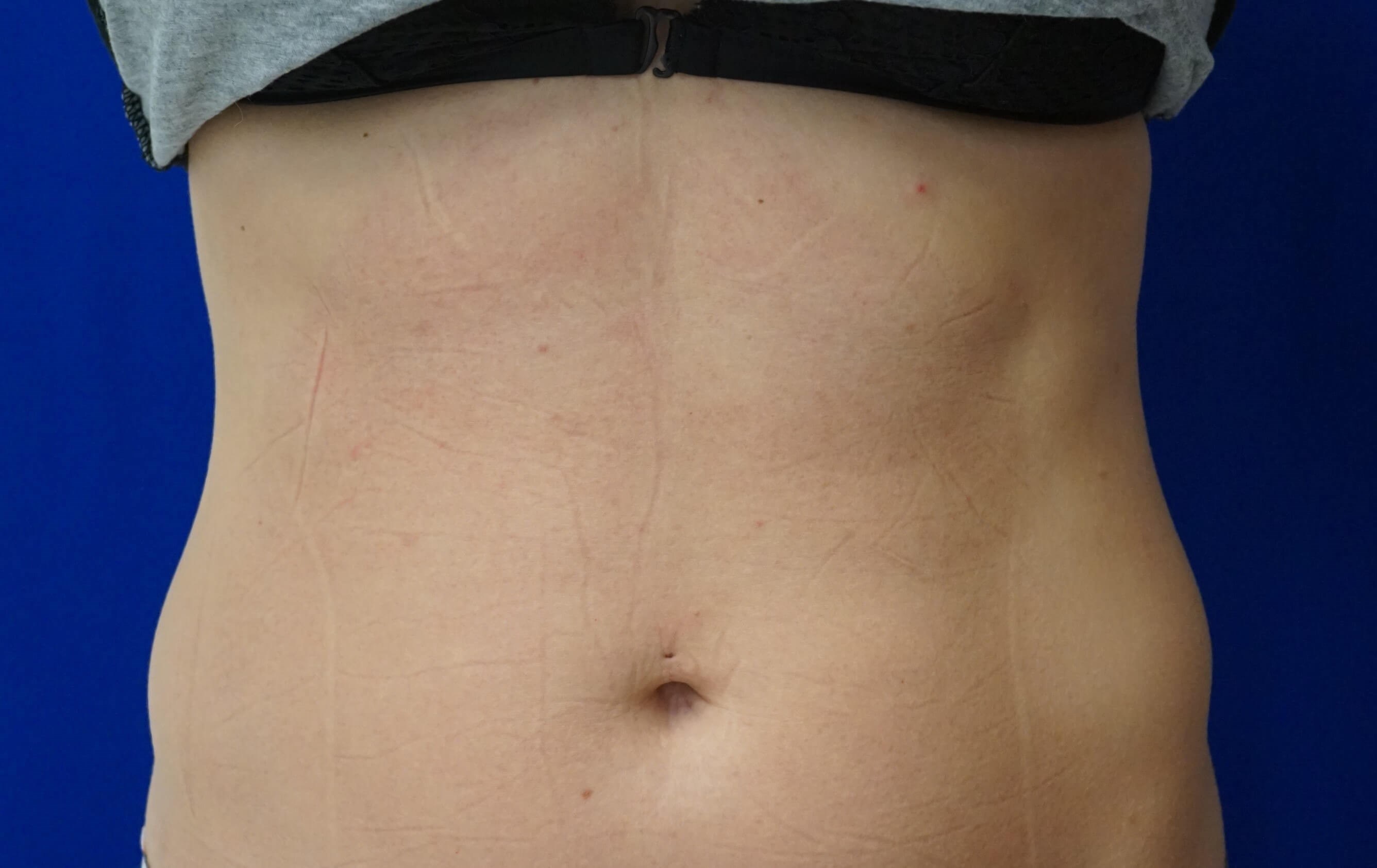 EMSCULPT  ABS After-4TH TREATMENT SESSION