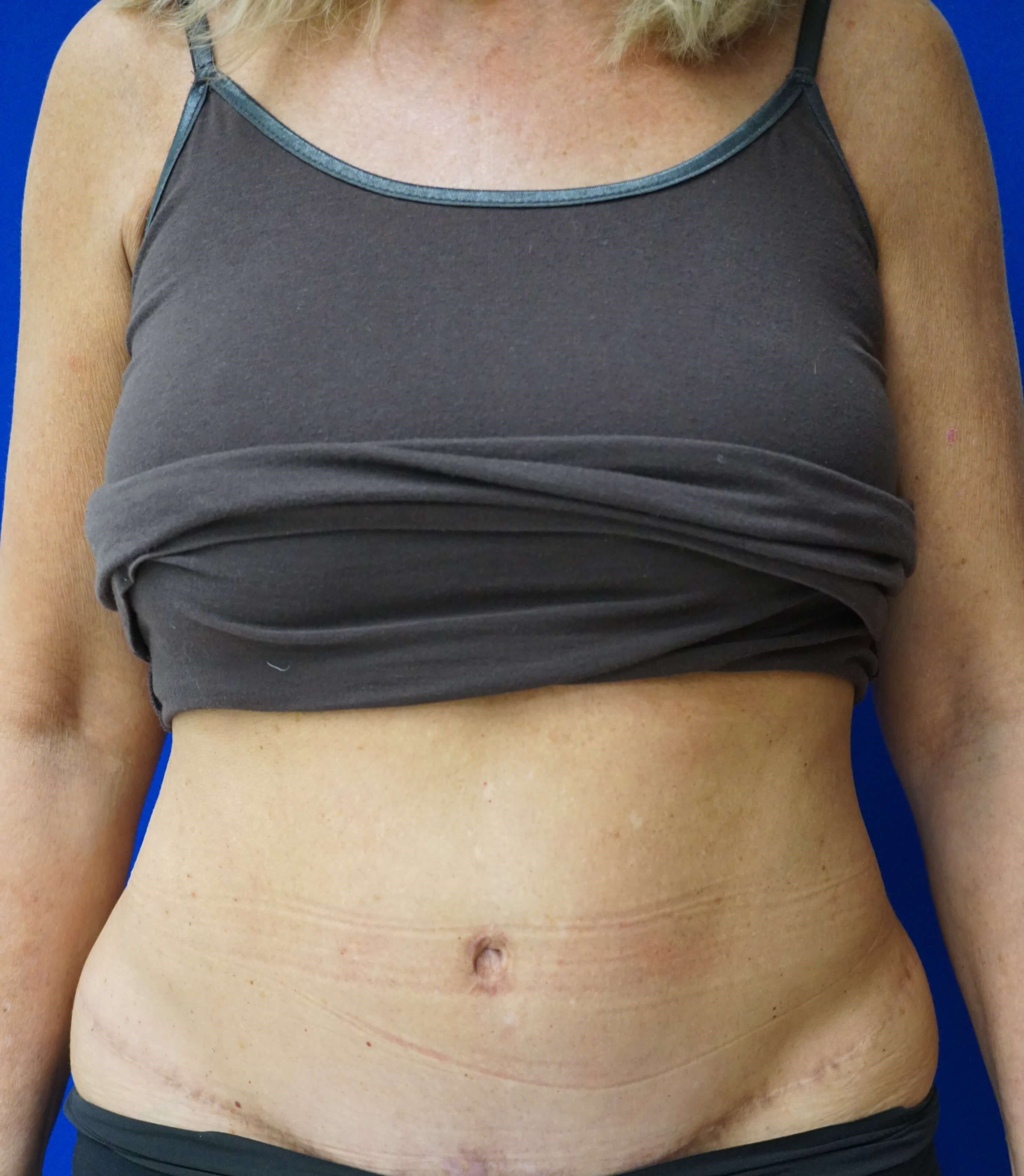 EMSCULPT  ABS Before