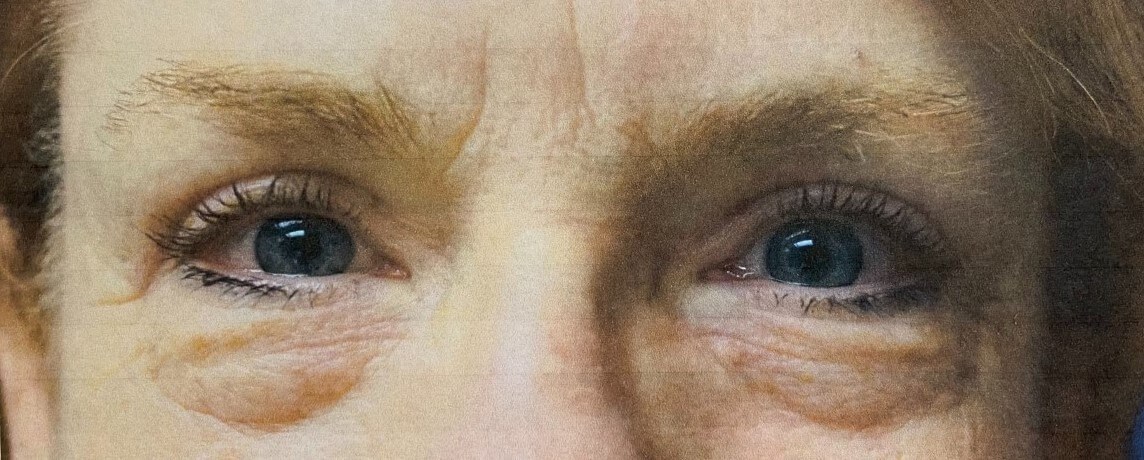 UPPER  BLEPHAROPLASTY After