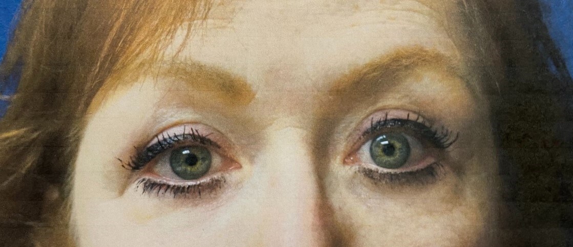 UPPER AND LOWER BLEPHAROPLASTY After