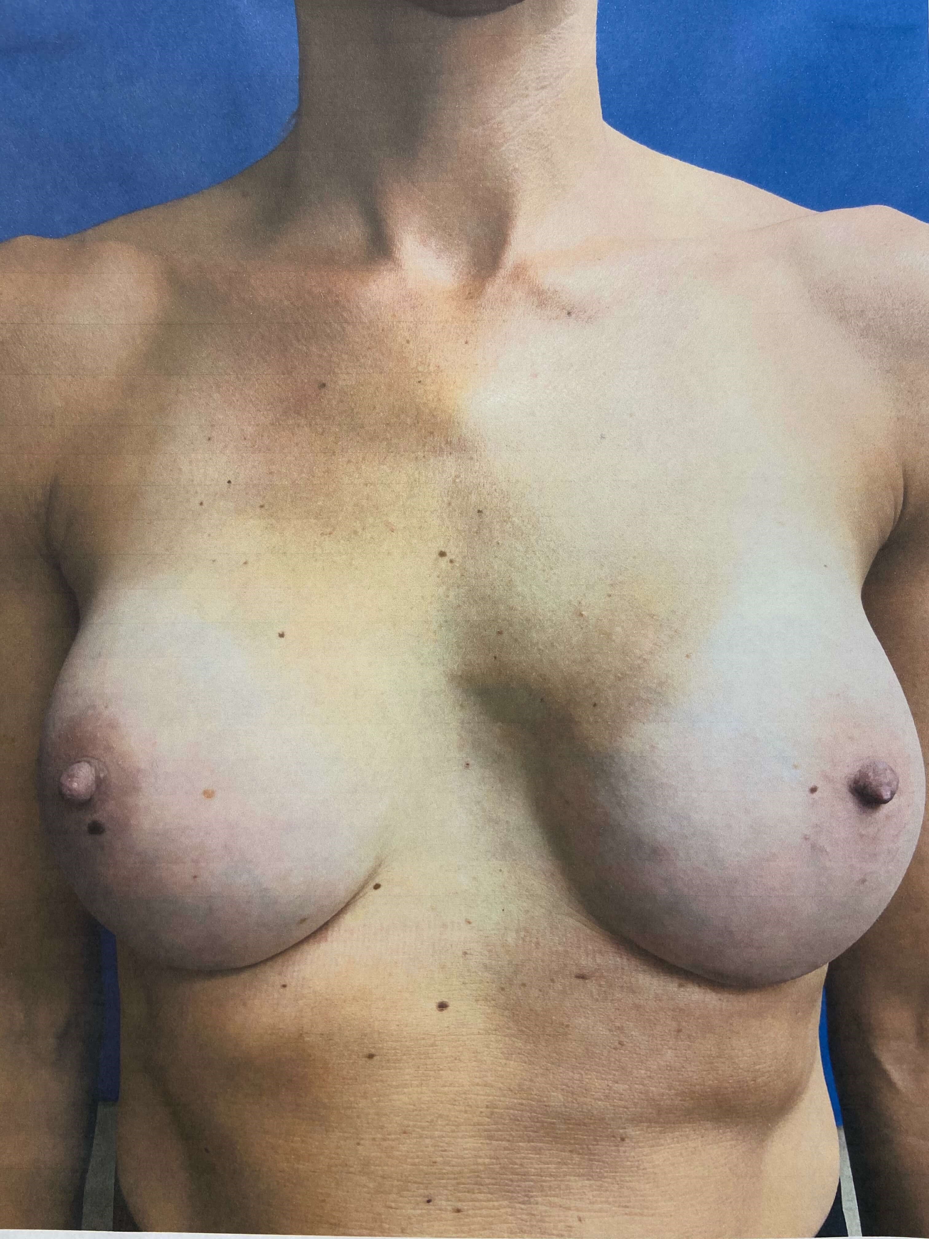 BREAST AUGMENTATION After
