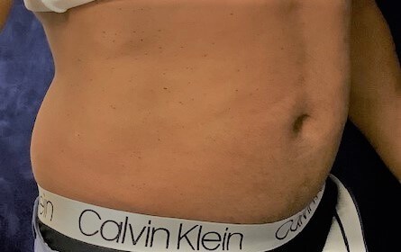 EMSCULPT After