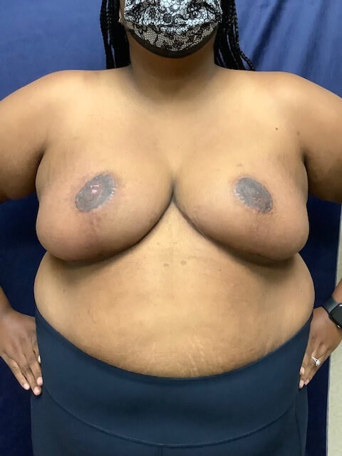 BBR WITH FREE NIPPLE GRAFTING After
