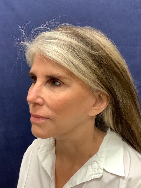 FACELIFT After