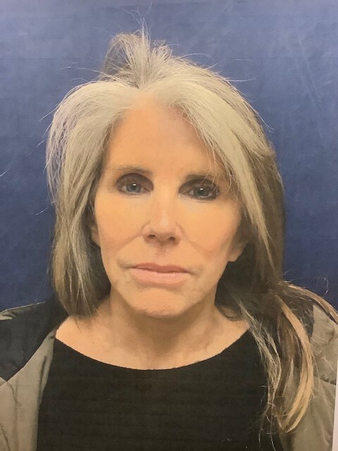FACELIFT Before