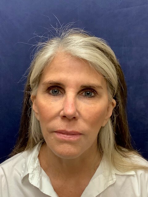 FACELIFT After