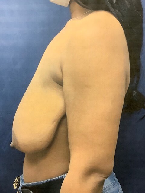 MASTOPEXY Before